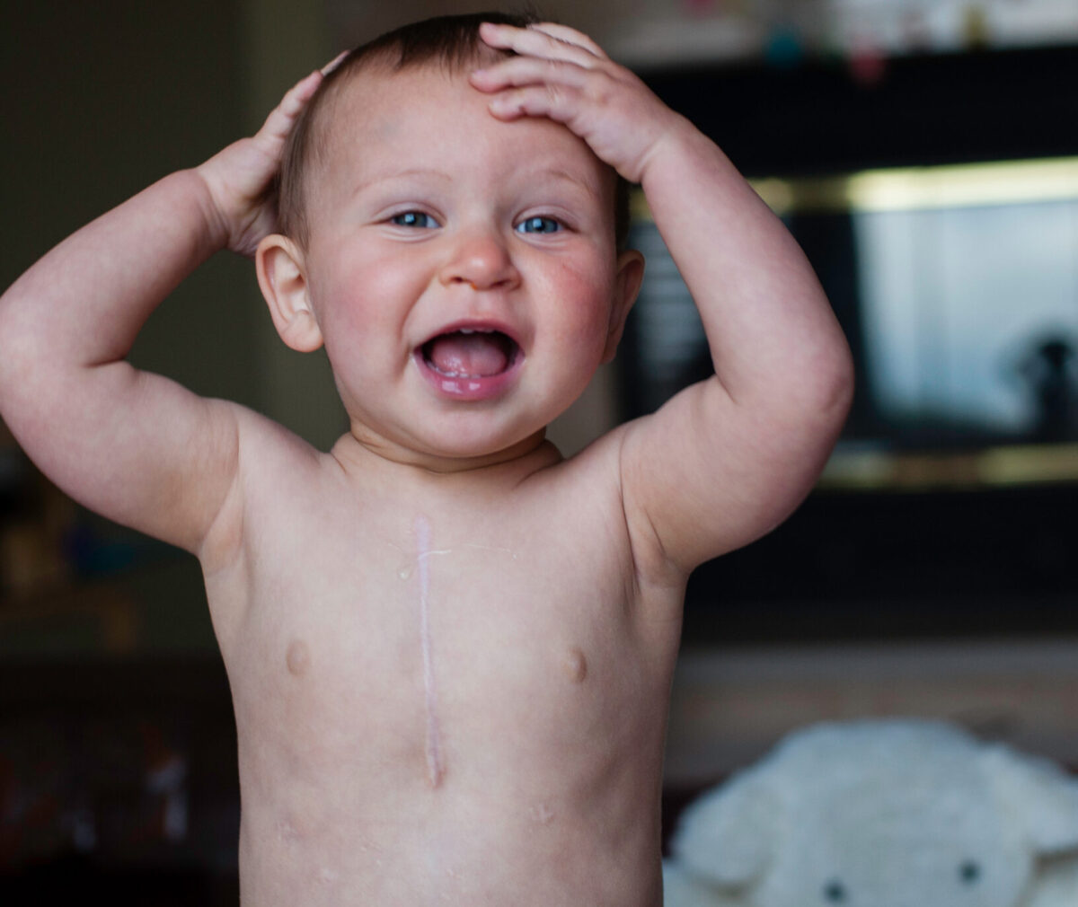 Baby Elena wearing on a diaper smiling to the camera with a visible scar running down the middle of her chest.
